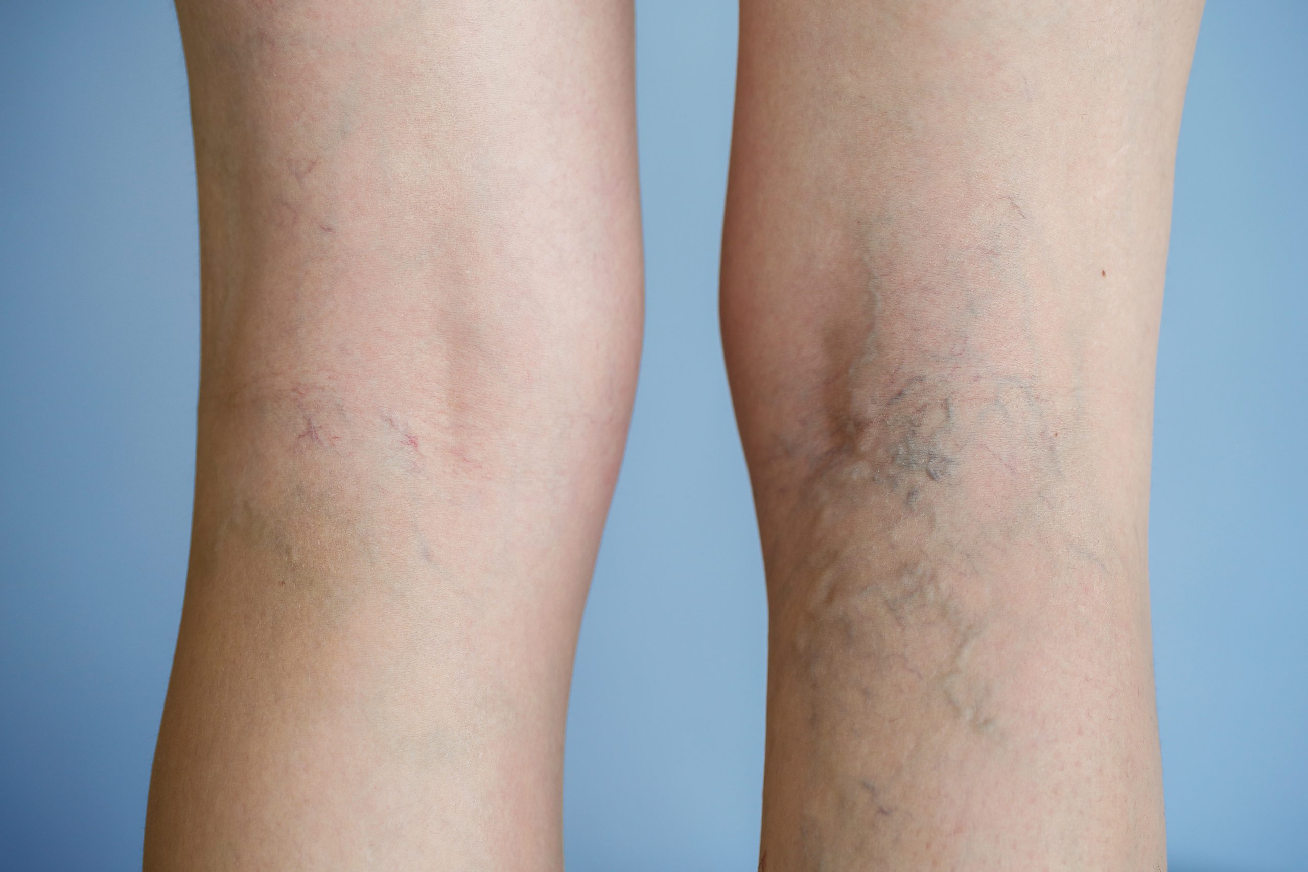 No Surgery; No Downtime: Sclerotherapy for Treating Varicose and