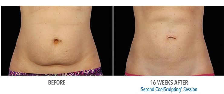 When seeking CoolSculpting treatment, it is important to find a good CoolSculpting doctor. In this article, we discuss what you should consider when choosing a CoolSculpting doctor