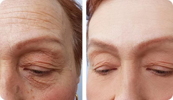 Botox is one of the best options for eliminating the appearance of fine lines and wrinkles in the forehead area. Botox works by temporarily paralyzing your muscles, which helps to smooth out persistent wrinkles. Wrinkles that are caused by muscle movement, known as dynamic wrinkles, will therefore respond to Botox treatment.