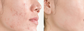 Dermaplaning treatment or ‘face shaving’ as it is sometimes referred to, with a chemical peel because they work in synergy together. By removing the outer layers of your skin via a dermaplaning treatment, a chemical peel will be able to penetrate more deeply and evenly into the layers of skin underneath, allowing it to work much more effectively.