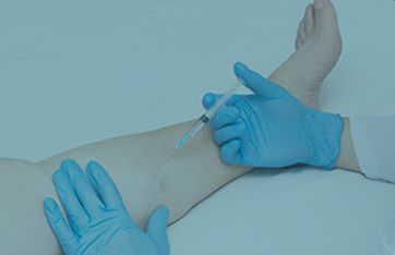 Sclerotherapy is a popular treatment choice for spider and varicose veins.