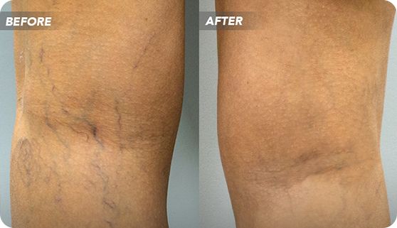 Sclerotherapy is a popular treatment choice for spider and varicose veins.