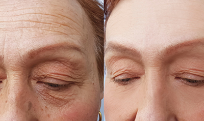 Botox injections are FDA-approved for the treatment of forehead lines. Typically, around 20 units of Botox are injected into the forehead to smooth out fine lines and wrinkles. Botox can be very effective at treating forehead lines because these lines tend to occur due to facial expressions.