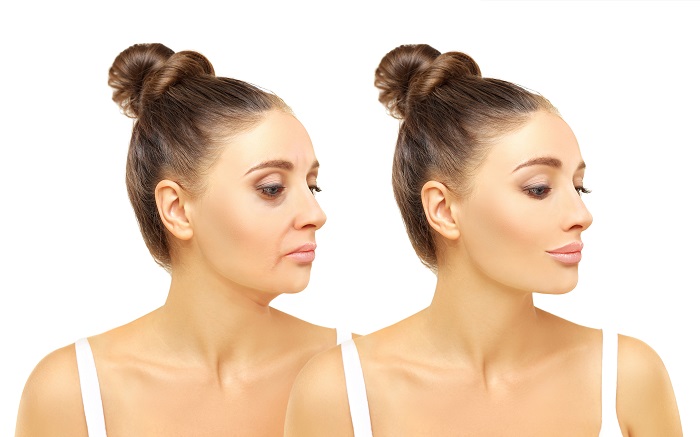 Hyaluronic Acid After Dermaplaning