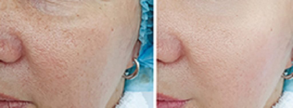 Microneedling is a minimally invasive procedure which is carried out using very fine precision needles which are contained on the surface of a micro needle roller.