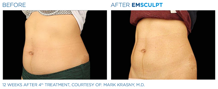 Body sculpting has become an affordable reality today through advanced non-invasive techniques such as Emsculpt. Book a session with a leading Emsculpt specialist in Boston to get that perfect figure!