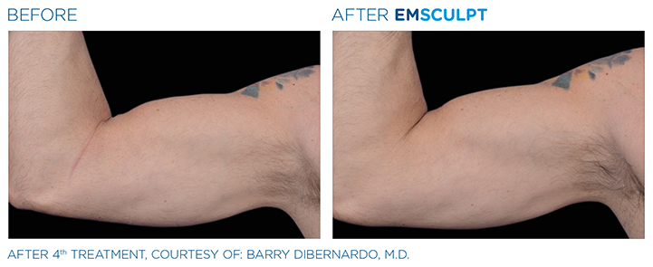 Emsculpt is a revolutionary, non-invasive treatment that can help you to build muscle and lose unwanted fat. Here, experts from a top Boston medical spa tell you all you need to know about Emsculpt in Natick, MA